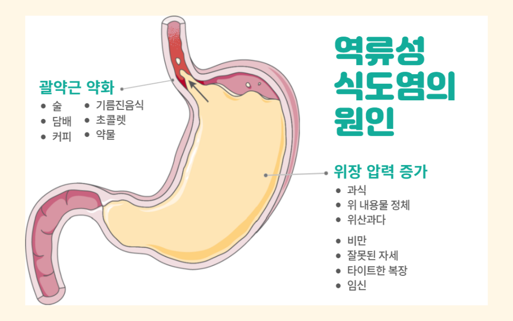 역류성 식도염 원인 인포그래픽